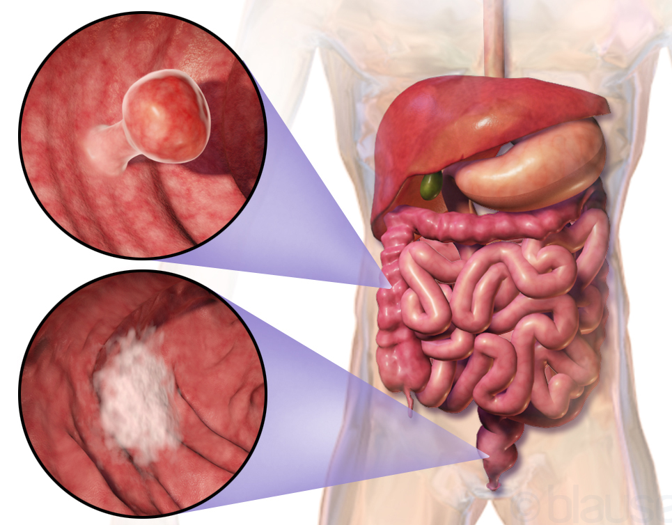 Waspadai Kanker Usus Besar: Penyebab, Gejala, dan Cara Pencegahannya