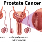 5 Kebiasaan Pembunuh Prostat pada Pria yang Wajib Dihindari